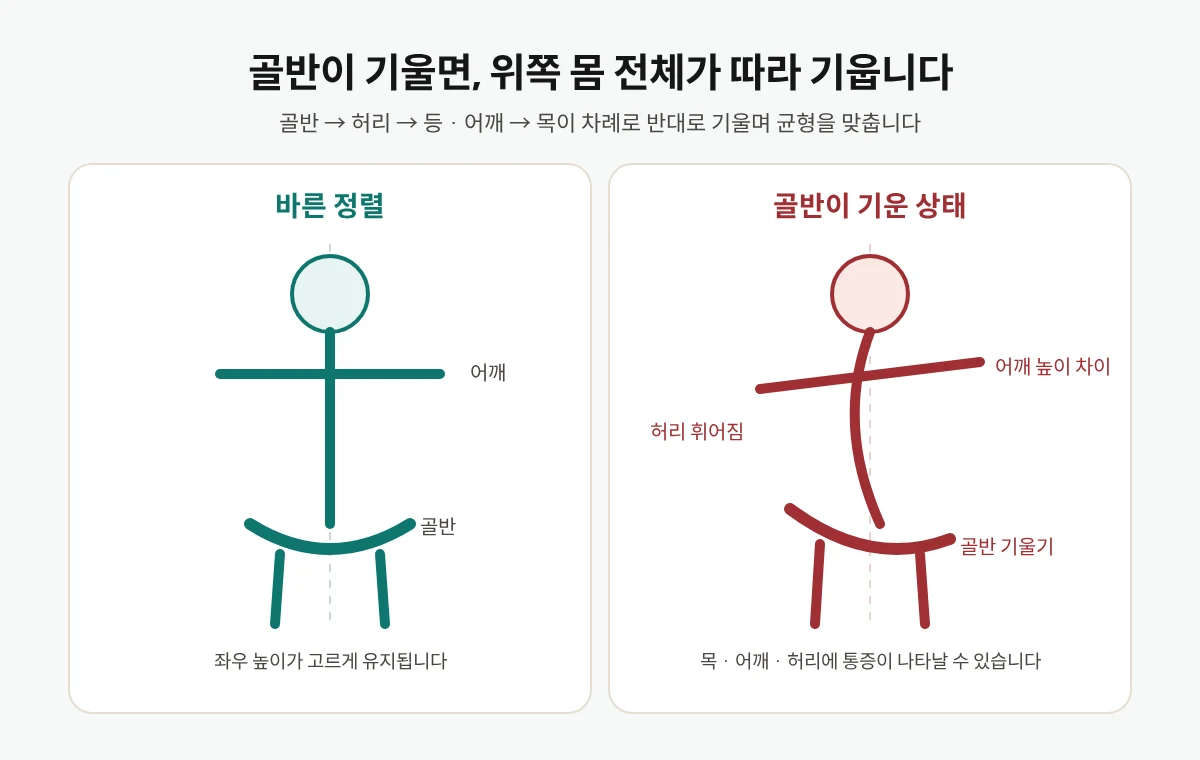 골반이 기울면 허리, 어깨, 목이 차례로 반대로 기우는 모습을 바른 정렬과 비교한 그림